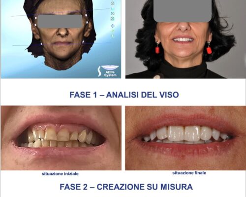 progettazione sorriso personalizzato Metodo AEP prima e dopo