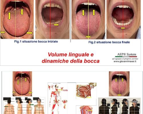Deglutizione e postura: lingua, occlusione ed equilibrio del corpo