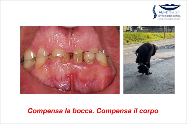 Compensi della bocca e del corpo associati a perdita di equilibrio del sistema stomatognatico nel Metodo AEP® System