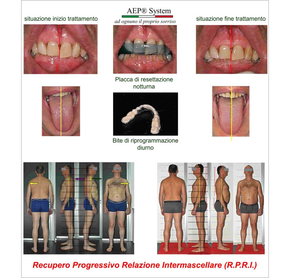Recupero Progressivo della Relazione Intermascellare AEP® System con miglioramento di equilibrio mandibolare, lingua e postura