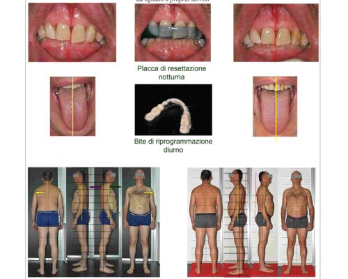 Recupero Progressivo della Relazione Intermascellare AEP® System con miglioramento di equilibrio mandibolare, lingua e postura