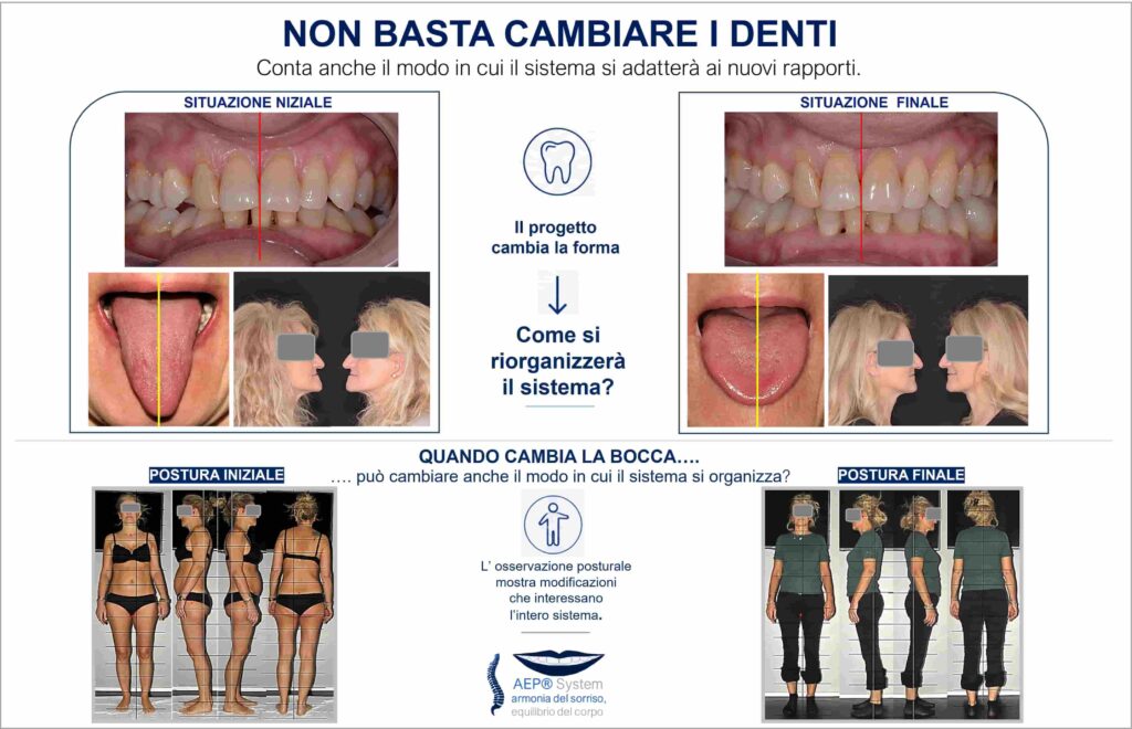 Caso clinico di riabilitazione protesica personalizzata osservato secondo il Metodo AEP® System, con confronto tra situazione iniziale e finale di denti, lingua e postura.