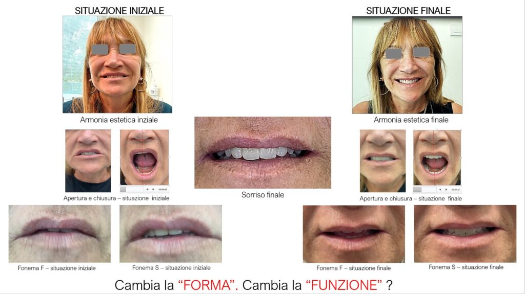 Caso clinico AEP® System prima e dopo la riabilitazione: confronto tra forma e posizione dei denti, apertura mandibolare e fonemi F e S.