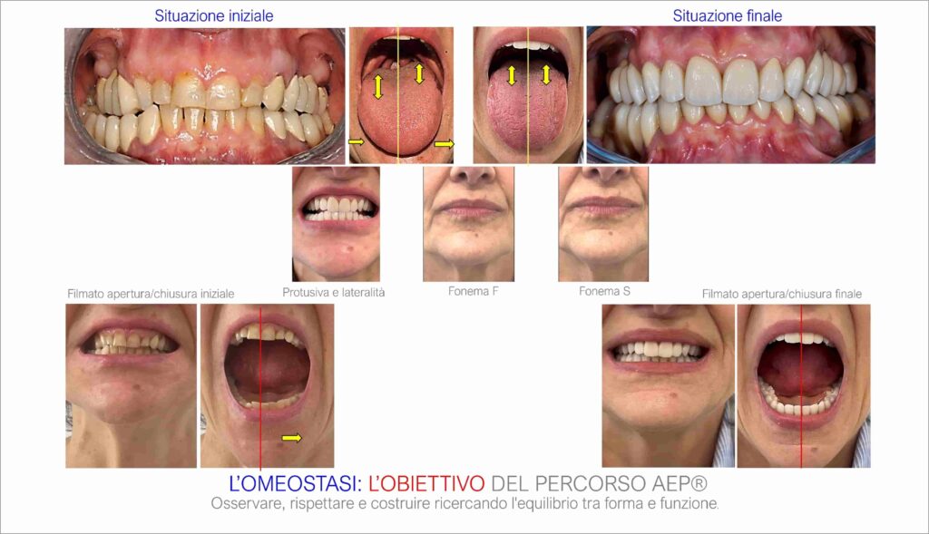 Confronto clinico AEP® System tra situazione iniziale e finale: posizione della lingua, apertura mandibolare e osservazioni dei fonemi F e S.