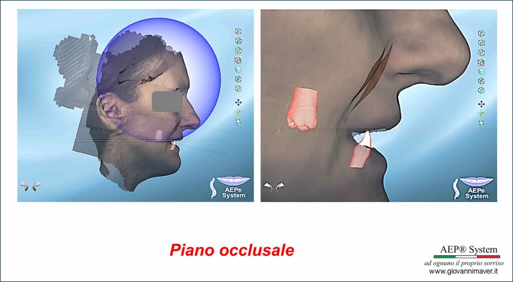 Piano occlusale nel Metodo AEP® System osservato in relazione ai riferimenti individuali del viso e alla posizione delle arcate dentali.