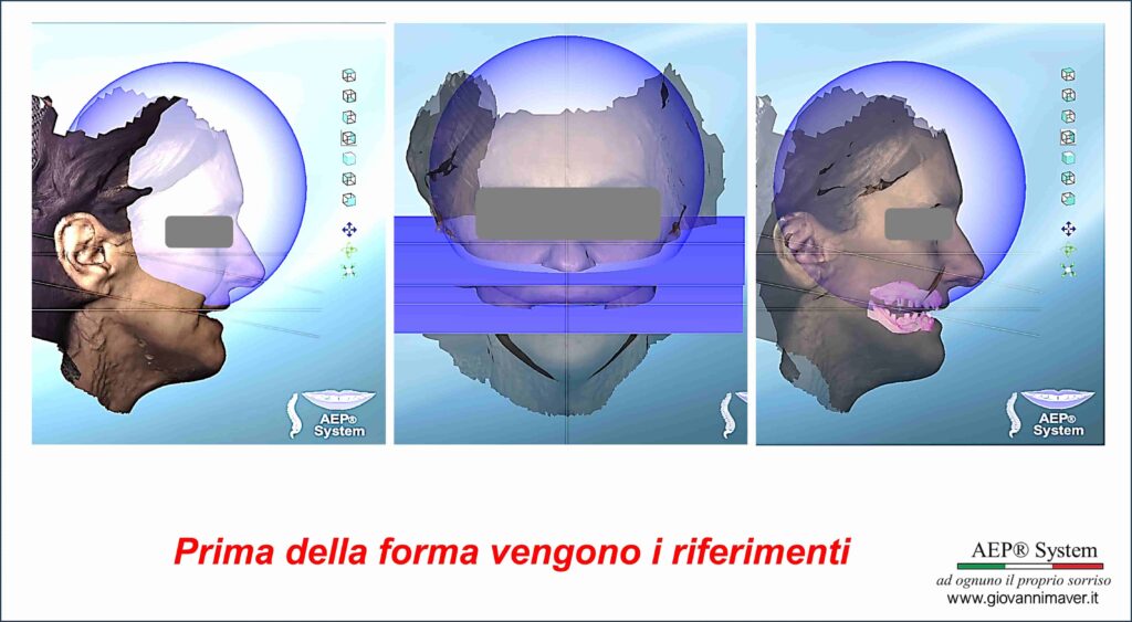 Riferimenti del viso e delle arcate nel Metodo AEP® System per definire piano occlusale e progettazione personalizzata del sorriso.