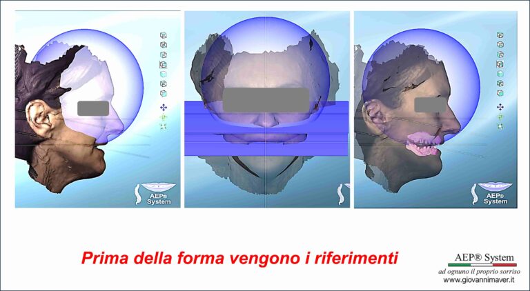 Riferimenti del viso e delle arcate nel Metodo AEP® System per definire piano occlusale e progettazione personalizzata del sorriso.