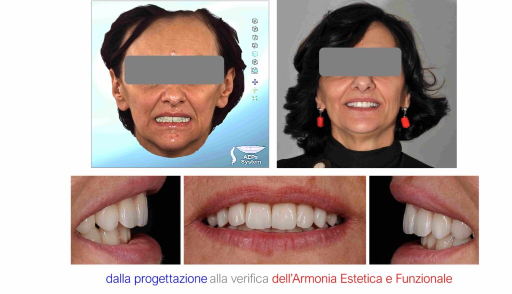 Caso clinico AEP® System: confronto del viso prima e dopo la riabilitazione protesica e osservazione del sorriso da diverse prospettive.