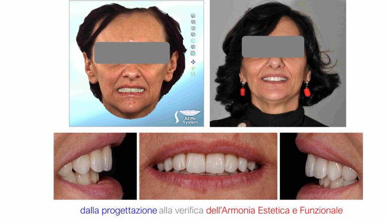 Caso clinico AEP® System: confronto del viso prima e dopo la riabilitazione protesica e osservazione del sorriso da diverse prospettive.